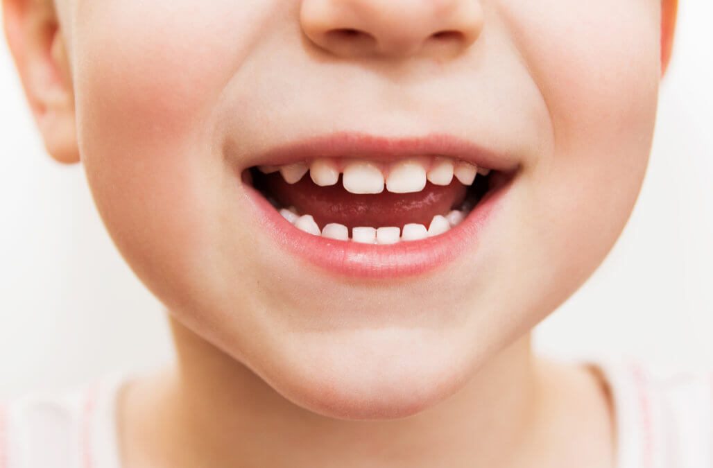 Children not getting dental check-ups early enough